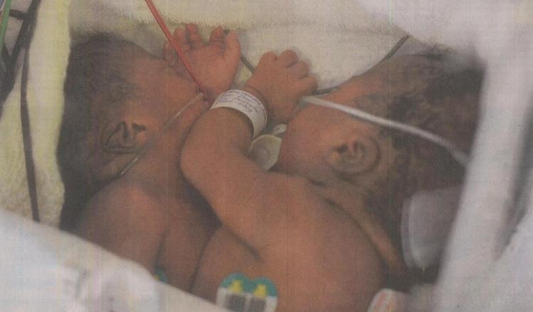 Conjoined twins flown in for Red Cross care